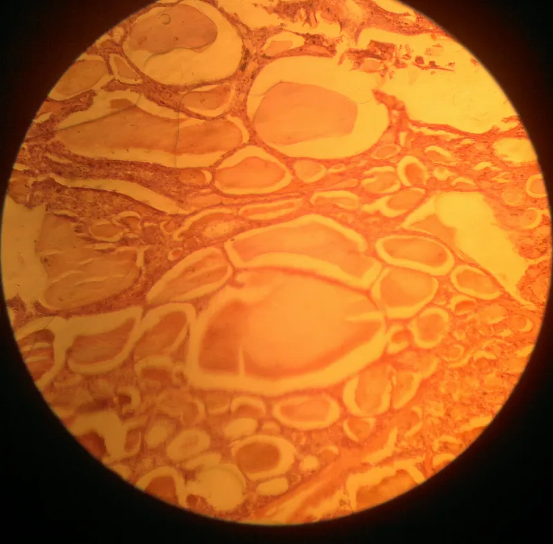 Pemberton's Sign and Substernal Goiter Compression