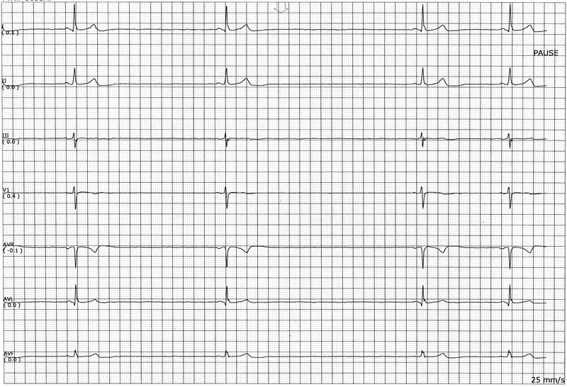 CAST Trial Showed Safer-Looking Heart Rhythms, Worse Survival
